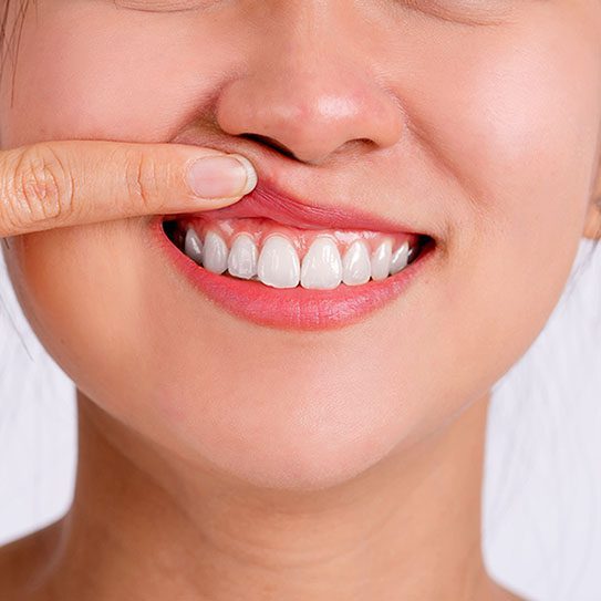 How Can I Defend Against Gum Recession? - Euclid Dental Center - Euclid Dental Center -