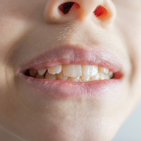 Gum Disease Can Affect Kids Too - Euclid Dental Center - Euclid Dental Center -
